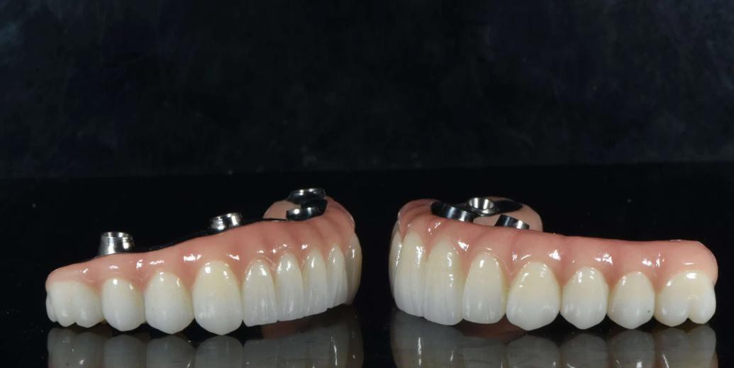 ALL-ON-X Zirconia Bridge ALL-ON-X Zirconia Bridge