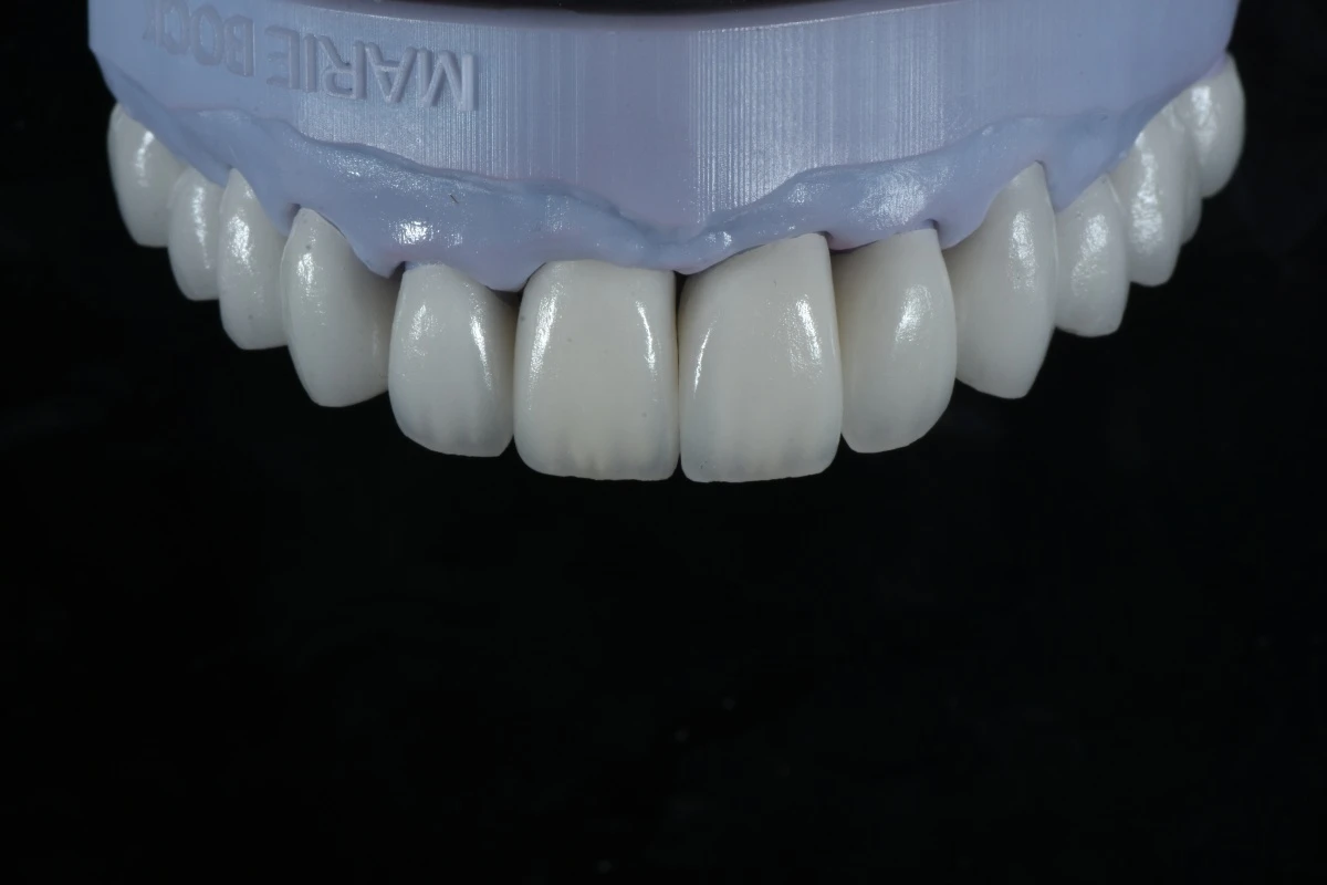 Natural-looking zirconia crowns with subtle surface texture and controlled luster Natural-looking zirconia crowns with subtle surface texture and controlled luster