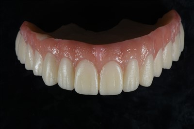 Akrilik Reçine Geçici Taç